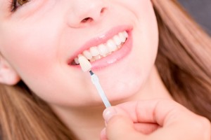 tipos de carillas dentales