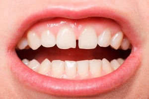 diastemas · separación de dientes